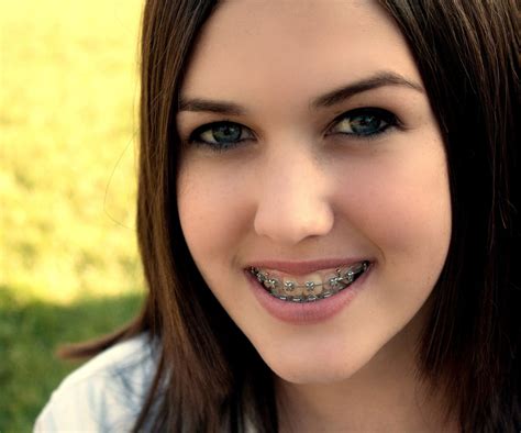 braces pinterest|beautiful women wearing braces.